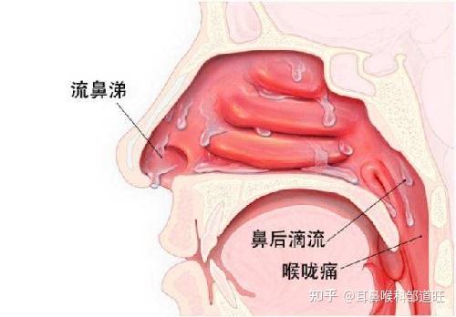 感冒的诊断与治疗：遵循标准，对症处理至关重要